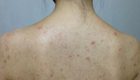 背部长痘的姑娘,后背有痘痘的女生