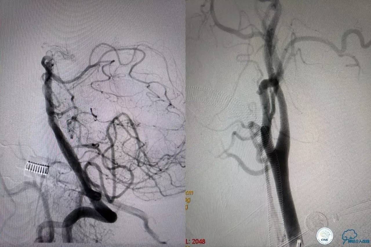 一例急性基底动脉尖综合征患者的支架取栓治疗
