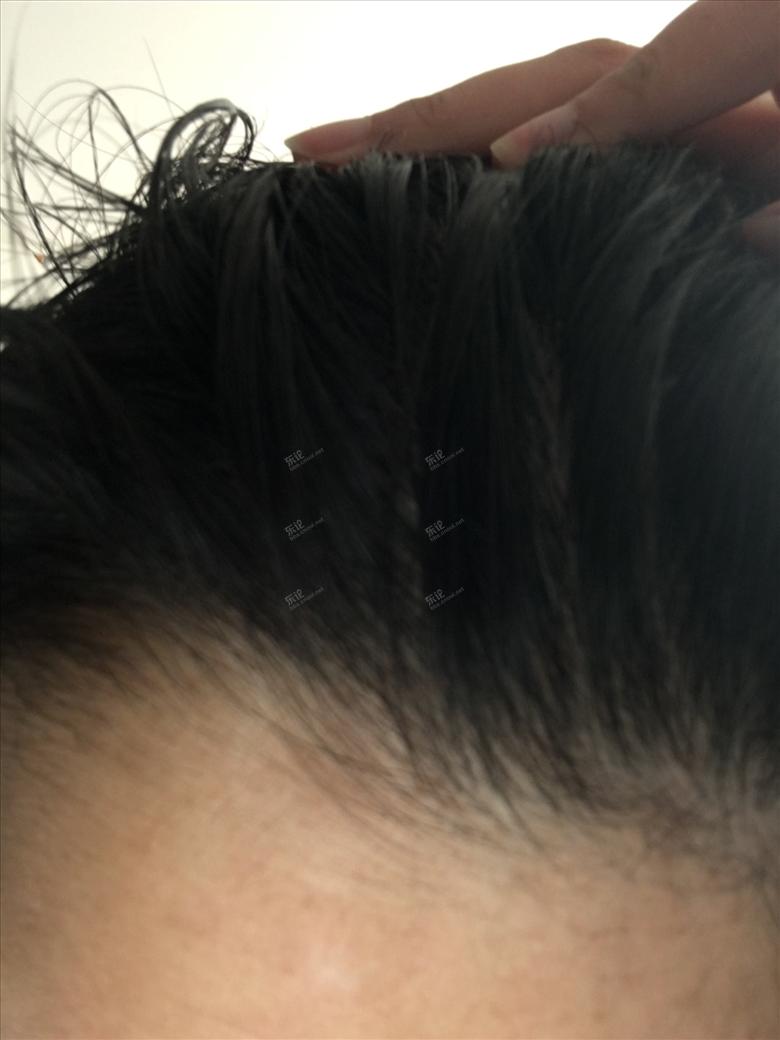 中医治头皮屑最快的妙招,头皮干燥头皮屑多偏方