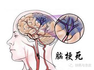 慢性脑梗塞怎么治疗最好呢,患脑梗塞的人怎么才能彻底治愈