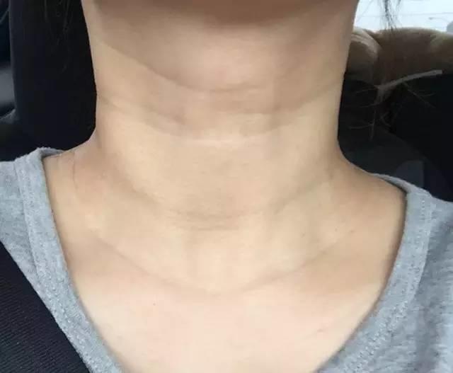 关于法令纹的种种误解,法令纹出现不要怕选对方法很重要