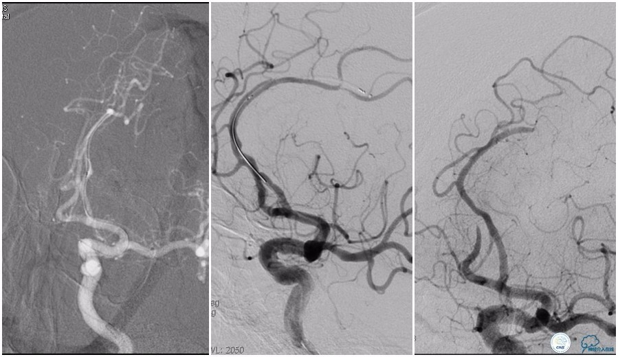 CINS2016病例展｜一例双侧大脑前动脉栓塞的再通治疗