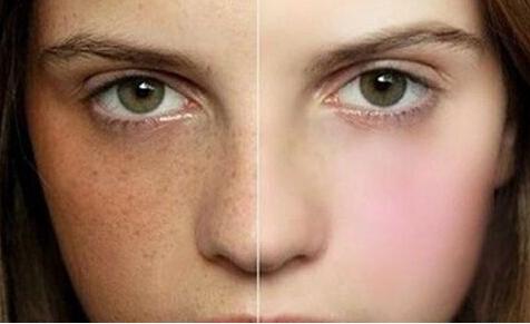 公认好用的祛斑方法,必看最好的祛斑方法