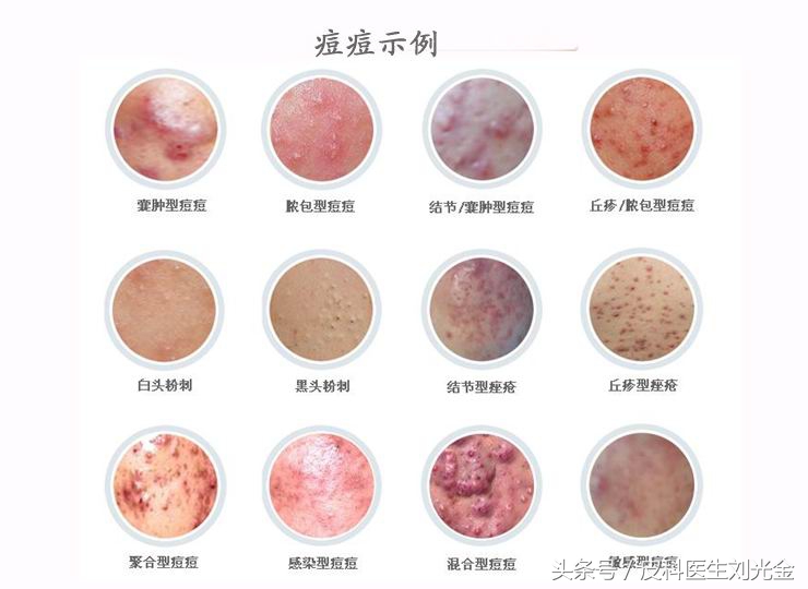 治疗青春痘套路,治疗青春痘最新视频