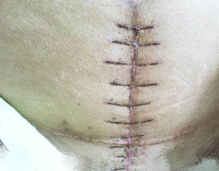 女人剖腹产之后腰疼,女人剖腹产之后的文案