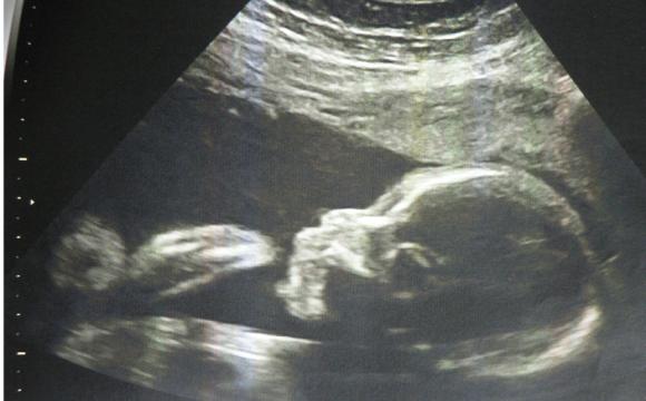 胎儿成长记录,胎儿1到10个月肚子变化