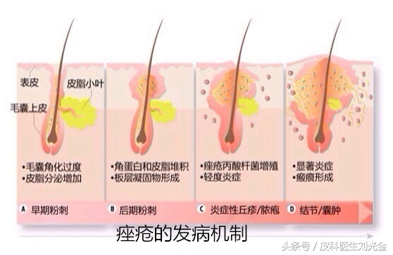 治疗青春痘套路,治疗青春痘最新视频