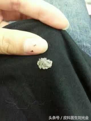 头皮屑多是不是缺少维生素b2,头皮屑多是不是皮肤病