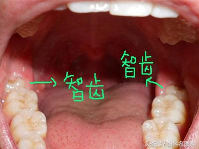 智齿一定要拔吗搞笑,智齿到底要不要拔掉会伤肾吗