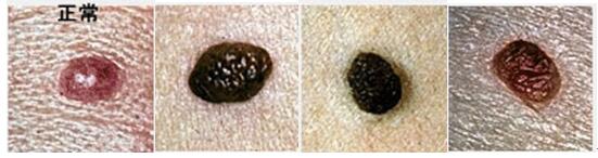 脸上肉痣可以随便切除吗,脸上的痣不能随便切吗