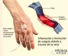 京医科普｜输液港：放心化疗，安心停靠！