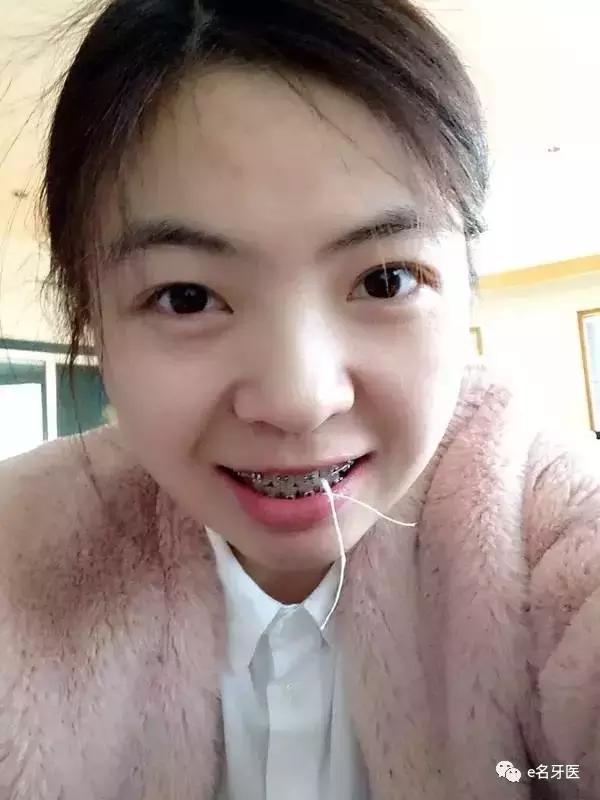 有牙洞并感觉到疼痛了,有牙洞很疼怎么办