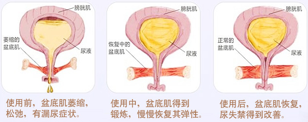 渭南妇幼保健院盆底康复治疗,渭南市人民医院盆底康复科