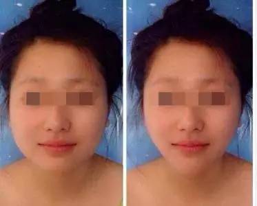 瘦脸针间隔8个月还可以打吗,瘦脸针打了多久不能躺着