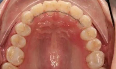 正畸力量过大牙齿一度松动怎么办,正畸引起的牙齿松动能恢复吗