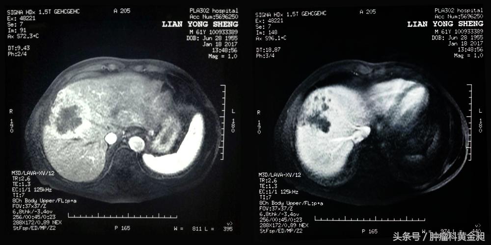肝癌介入栓塞化疗的副作用,肿瘤介入手术栓塞血管