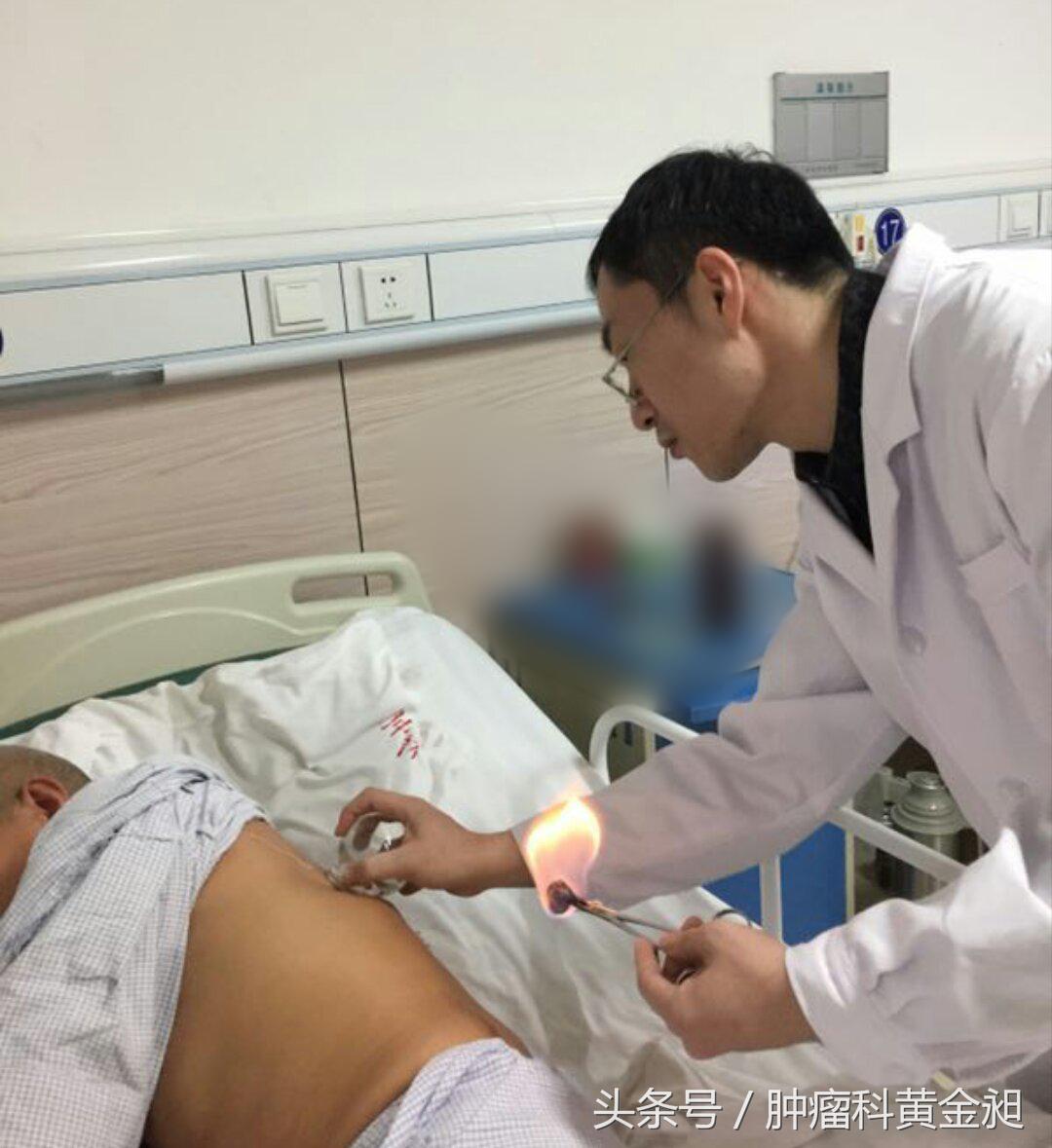 肝癌介入栓塞化疗的副作用,肿瘤介入手术栓塞血管