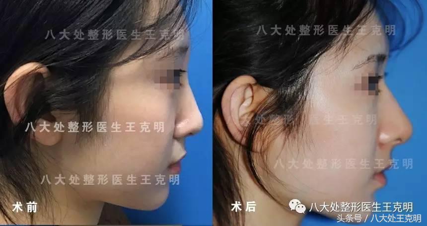 肋软骨隆鼻如何选择合适的形态,肋软骨隆鼻和耳软骨隆鼻哪个安全