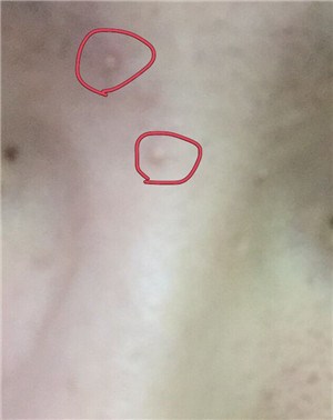 长痘痘如何正确挤,长痘痘怎么挤爆