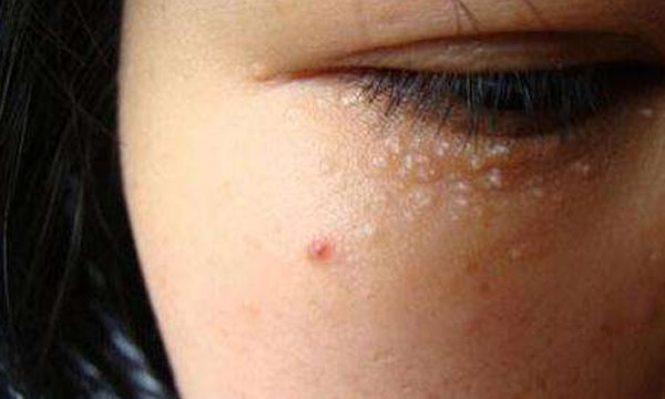 眼睛周围长满脂肪粒是怎么回事,眼睛周围长满了脂肪粒是怎么回事