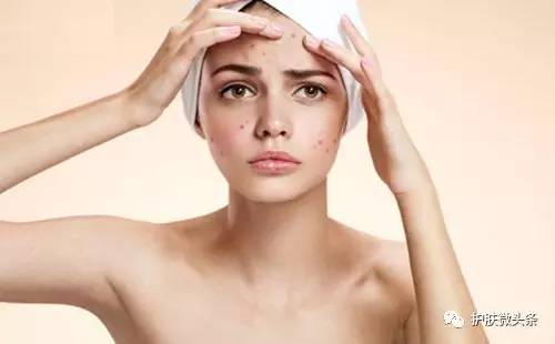 挤痘痘留下的痘印大概多久会好,挤痘留下的红色痘印怎么祛除