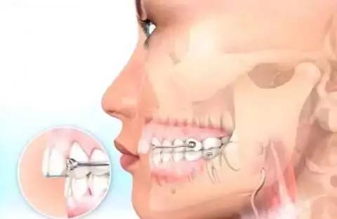 如何一秒钟矫正牙齿,牙齿矫正让你悄然改变从现在开始