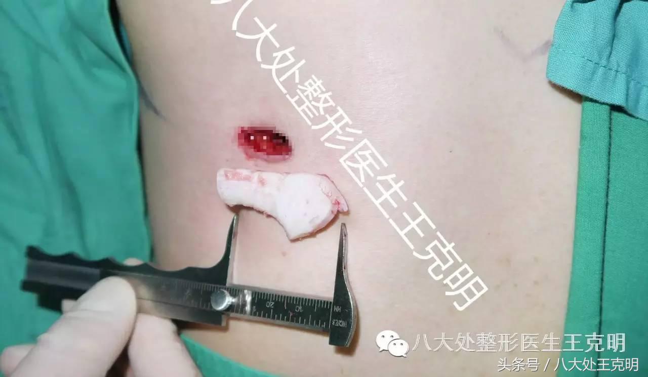 肋软骨隆鼻如何选择合适的形态,肋软骨隆鼻和耳软骨隆鼻哪个安全