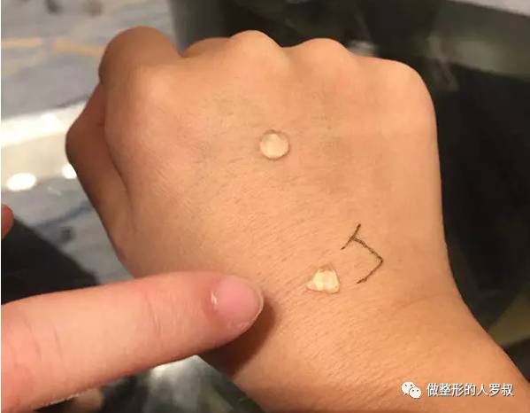 罗叔：10问玻尿酸（建议收藏）