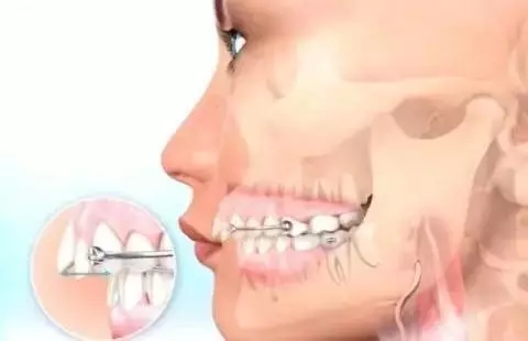 如何一秒钟矫正牙齿,牙齿矫正让你悄然改变从现在开始