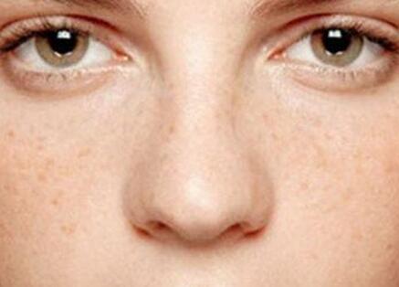 去除脸上斑点最有效的方法,斑点去除最快的方法