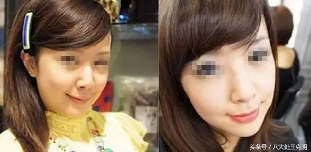 瘦脸针三次真的能定型吗,瘦脸针打三次就可以永久定型了吗