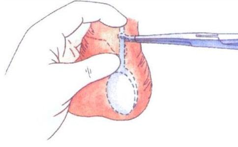 男性结扎还是女性结扎伤害大,结扎对女性的伤害