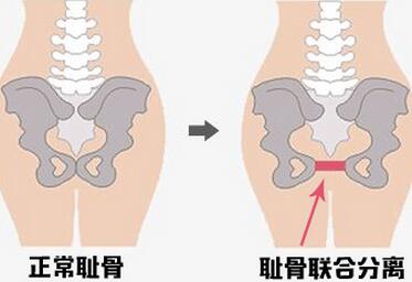 都说顺产好恢复，我顺产后却痛了近两个月！