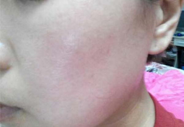 脸上有红血丝如何修复红血丝,脸上有红血丝怎么办消除红血丝