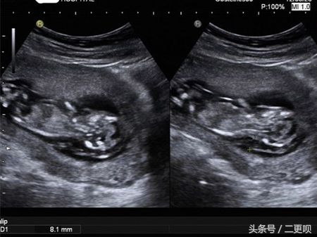 nt检查11周去还是12周去比较好,孕12-16周做nt检查需要注意什么