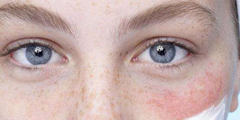 过敏受损肌肤如何保湿修复,换季就过敏保护好肌肤怎样都不怕