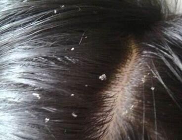 严重的头皮屑怎么也去不掉怎么办,头皮屑一直去不掉怎么办