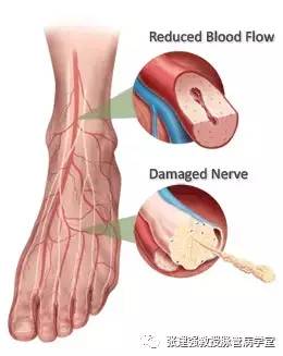 糖尿病足溃疡治疗方法,糖尿病足慢性溃疡修复术