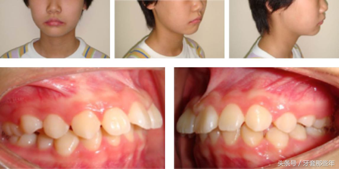 戴牙套矫正要打骨钉吗,矫正先拔牙还是先戴牙套