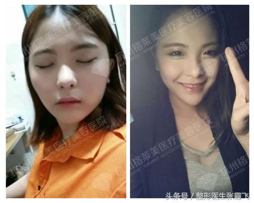 瘦脸针能瘦脸这种说法正确吗,瘦脸针真的能起到瘦脸的效果吗