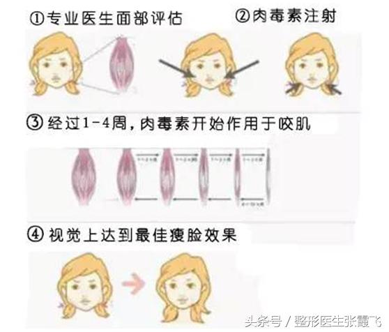 瘦脸针能瘦脸这种说法正确吗,瘦脸针真的能起到瘦脸的效果吗