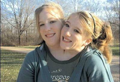 连体双胞胎能互相控制不,连体双胞胎正确生活方式