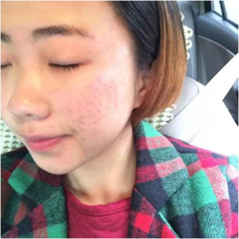 长痘痘黑头粉刺注意什么,青春期脸上长痘痘饮食注意什么