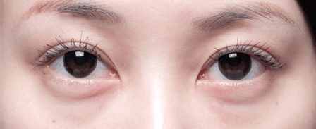 卧蚕与眼袋别傻傻分不清楚,卧蚕眼袋黑眼圈傻傻分不清楚