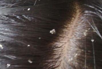 刚洗完头头皮屑特别多是什么原因,头特别痒头皮屑特别多是什么原因