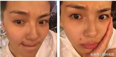 嘴巴周围反复长痘痘怎么快速去除,女人嘴巴周围起痘痘什么原因