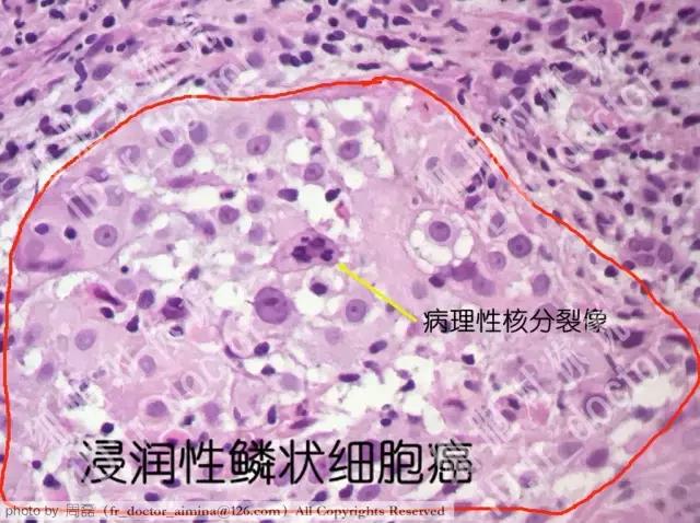 宫颈癌前病变cin2治愈率,宫颈管内癌前病变属于cin么