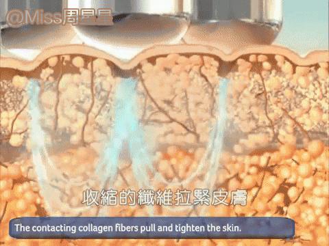 这个高科技，真的能还你十年胶原蛋白？