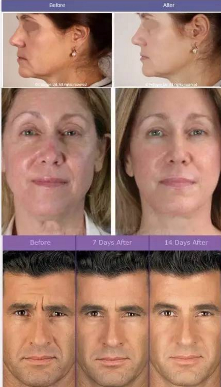 这个高科技，真的能还你十年胶原蛋白？