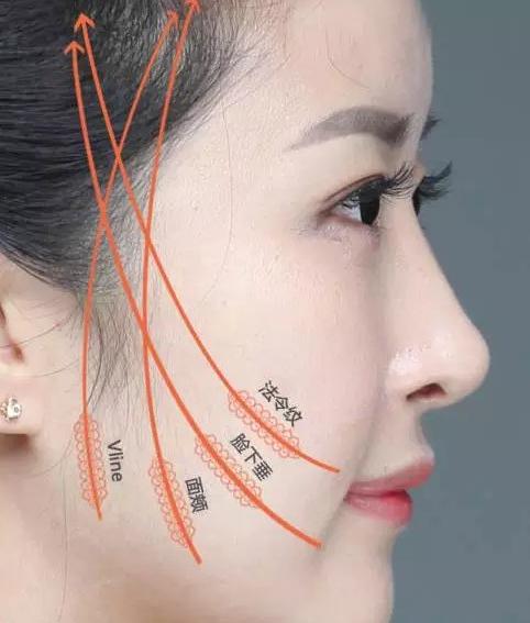 最火的徒手面部提拉,3d面部柔线提拉术